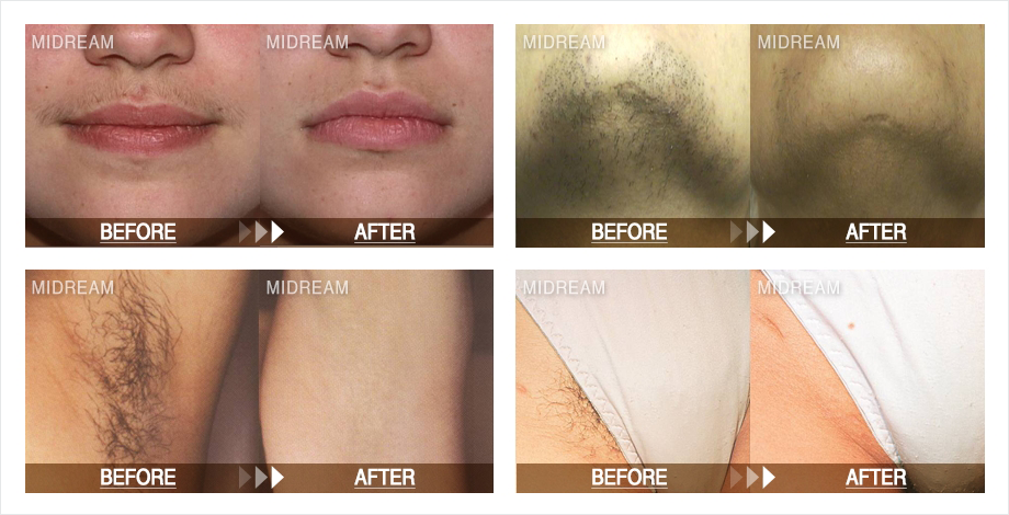 라이트쉬어 듀엣제모