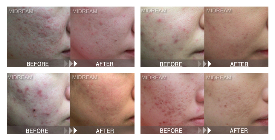 브이빔 듀엣제모