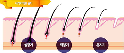 모근의 진행 3단계